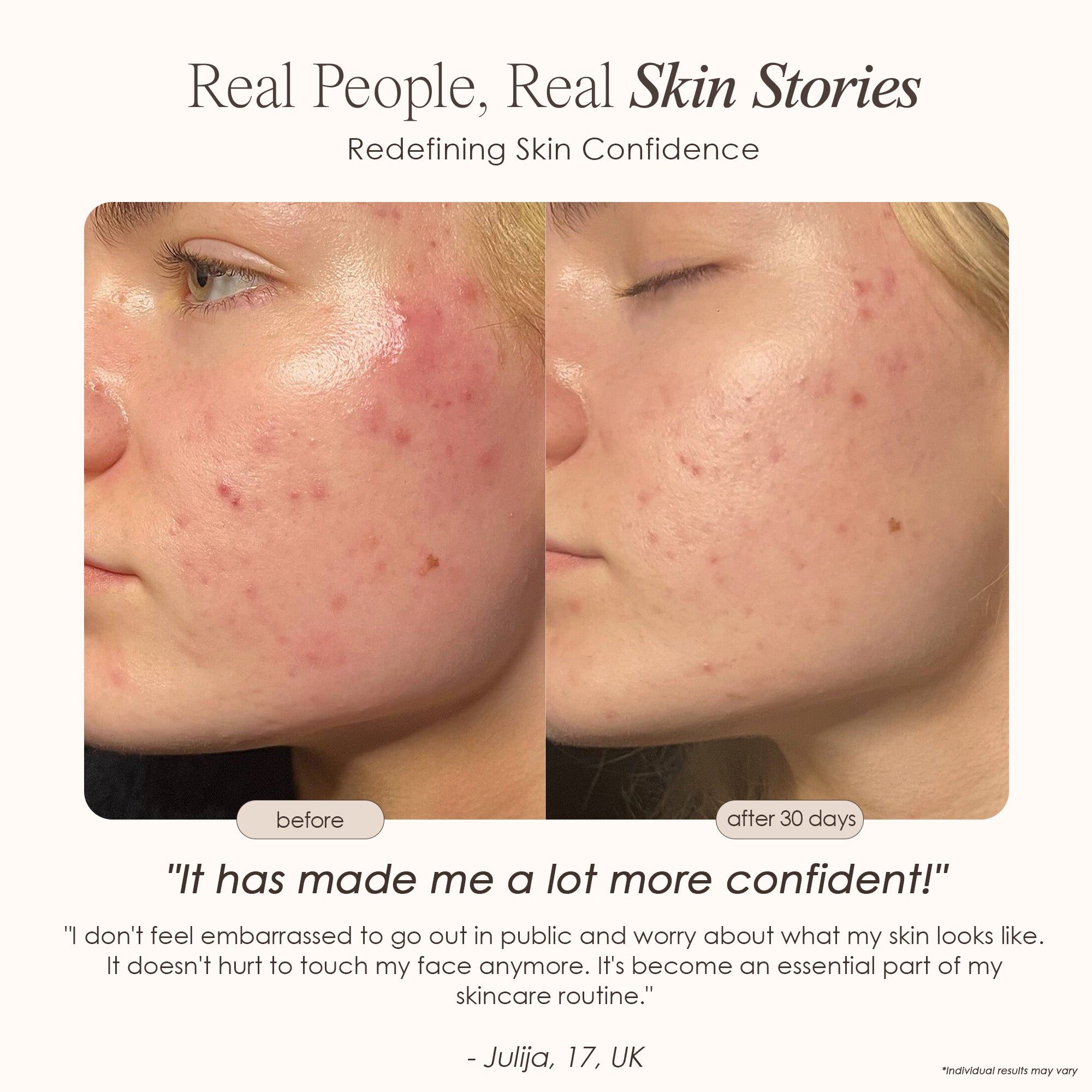 LightAura LED face mask before and after where it doesn’t hurt to touch the face anymore after 30 days