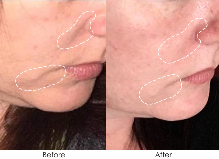 SkinSonic LED Ultrasonic Wand EMS before and after results showing reduced wrinkles and fine lines