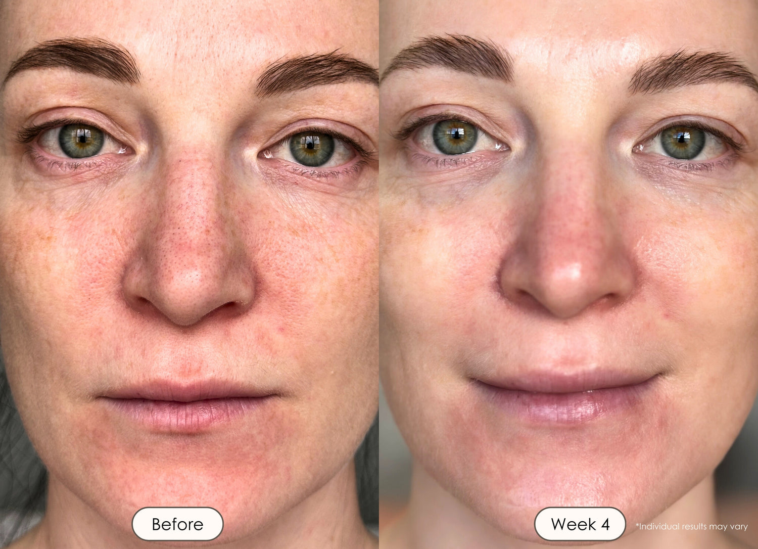 Visible results after 4 weeks of using the LED light therapy face and neck mask